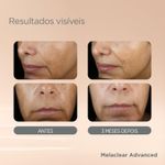 Sérum Facial Clareador Isdin Melaclear Advanced 30ml